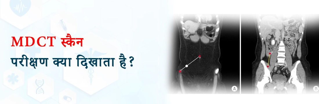MDCT स्कैन: परीक्षण क्या दिखाता है?